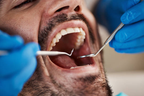 Best Knocked-Out Tooth (Avulsed Tooth) Treatment in Hebron Estates, KY